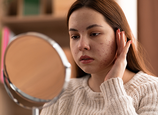 Acne -common skin problem of teenagers -Knowledge & solution